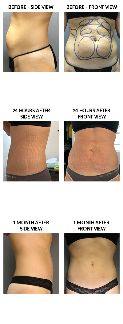 SOCO-LipoCaseStudy