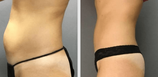 Microcannula Tumescent Liposuction Irvine