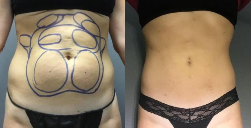 Microcannula Tumescent Liposuction Irvine