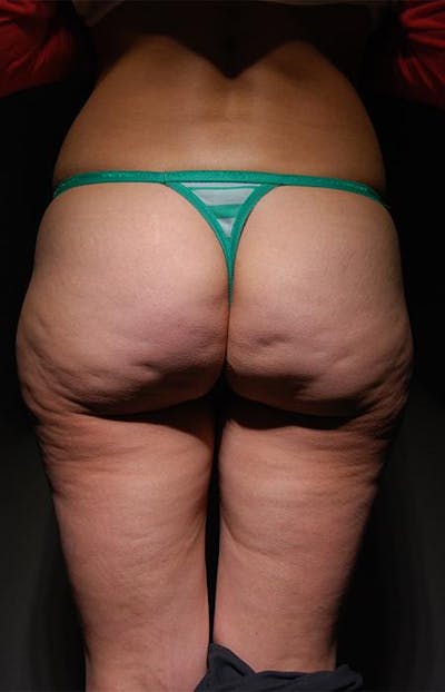 Cellfina Before & After Gallery - Patient 5070406 - Image 1