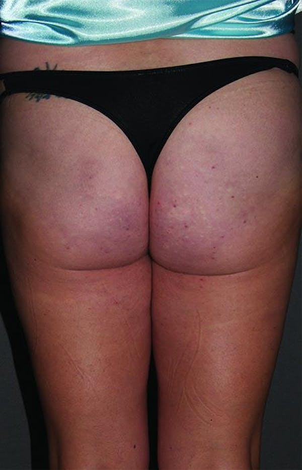 Cellfina Before & After Gallery - Patient 5070412 - Image 2