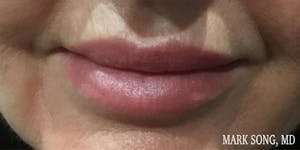 Before and After image of Lip Augmentation