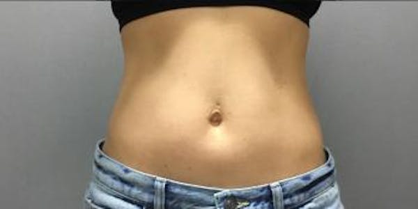 Before and after image of EMSCULPT