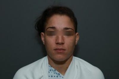 Functional Rhinoplasty Before & After Gallery - Patient 5070453 - Image 1