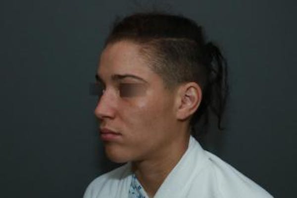 Functional Rhinoplasty Before & After Gallery - Patient 5070453 - Image 3