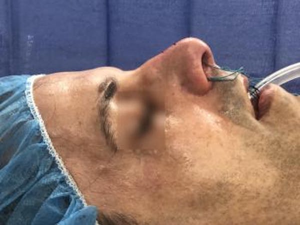 Functional Rhinoplasty Before & After Gallery - Patient 5070456 - Image 1