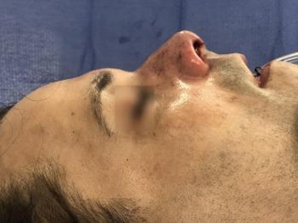 Functional Rhinoplasty Before & After Gallery - Patient 5070456 - Image 2