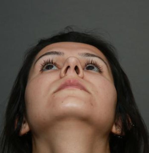 Before and after image of Septoplasty