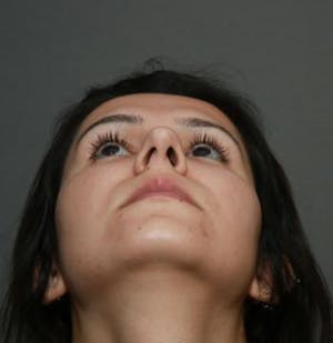 Before and after image of Septoplasty