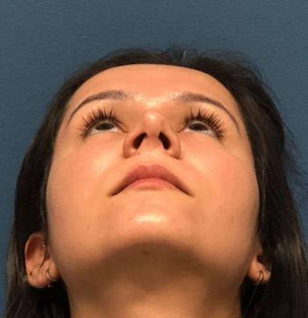 Before and after image of Septoplasty