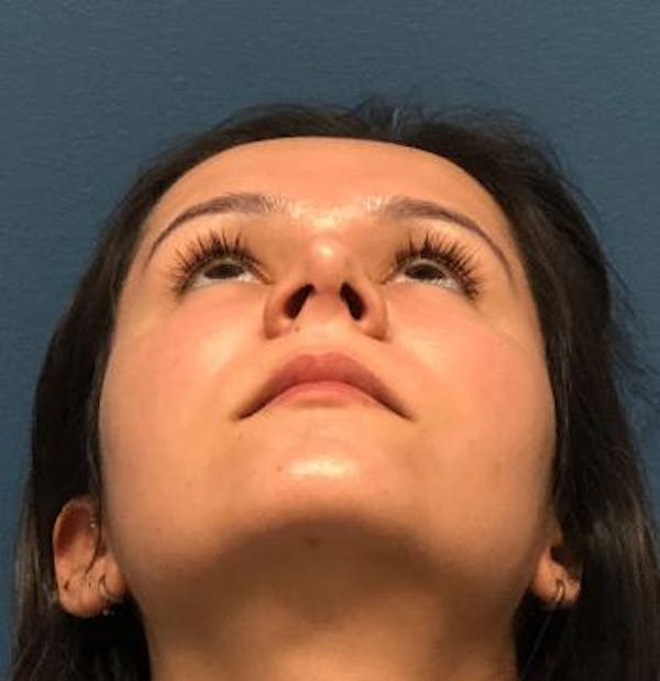 Functional Rhinoplasty Before & After Gallery - Patient 5070465 - Image 2