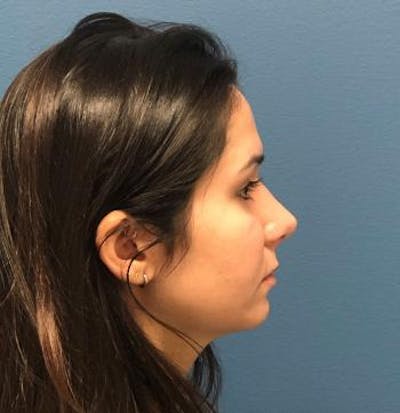 Functional Rhinoplasty Before & After Gallery - Patient 5070465 - Image 4