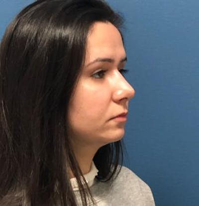 Functional Rhinoplasty Before & After Gallery - Patient 5070465 - Image 8