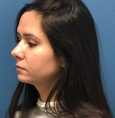 Functional Rhinoplasty Before & After Gallery - Patient 5070465 - Image 10