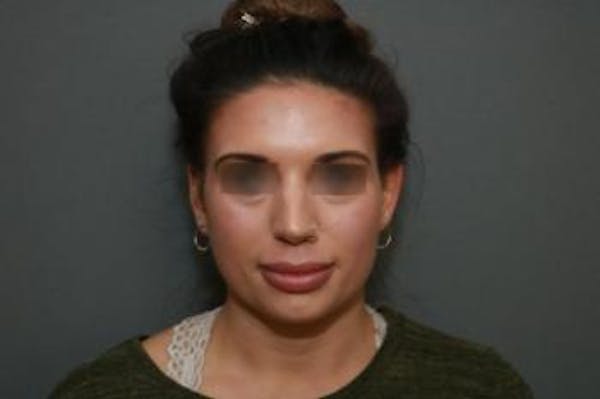Aesthetic Rhinoplasty Before & After Gallery - Patient 5070476 - Image 1