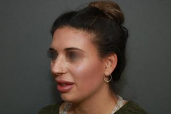 Aesthetic Rhinoplasty Before & After Gallery - Patient 5070476 - Image 3
