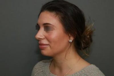 Aesthetic Rhinoplasty Before & After Gallery - Patient 5070476 - Image 4