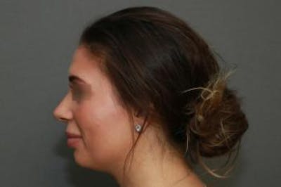 Aesthetic Rhinoplasty Before & After Gallery - Patient 5070476 - Image 6