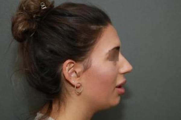 Aesthetic Rhinoplasty Before & After Gallery - Patient 5070476 - Image 9
