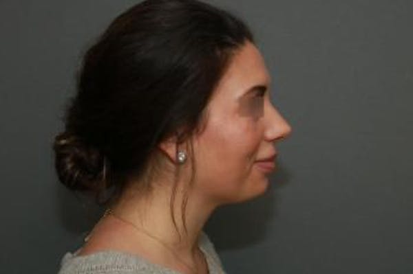 Aesthetic Rhinoplasty Before & After Gallery - Patient 5070476 - Image 10