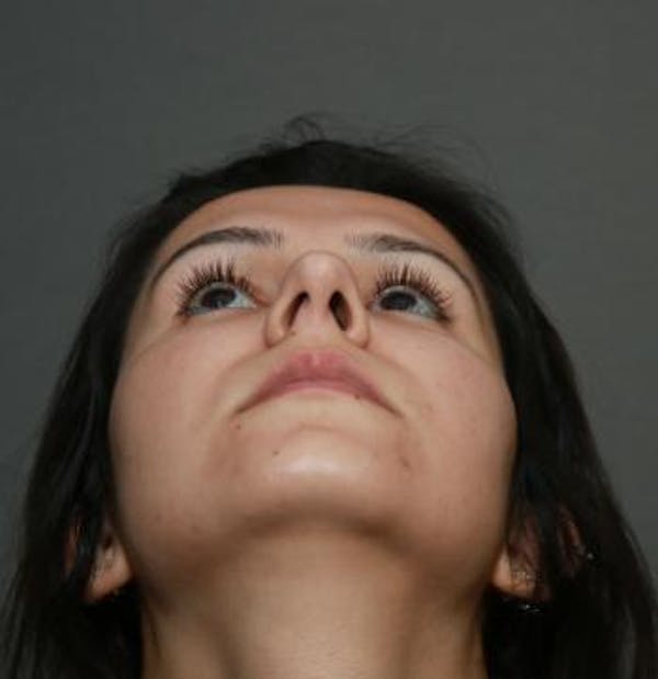 Aesthetic Rhinoplasty Before & After Gallery - Patient 5070483 - Image 3