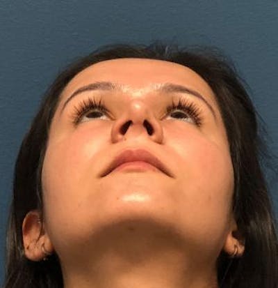 Aesthetic Rhinoplasty Before & After Gallery - Patient 5070483 - Image 4