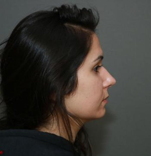 Aesthetic Rhinoplasty Before & After Gallery - Patient 5070483 - Image 5
