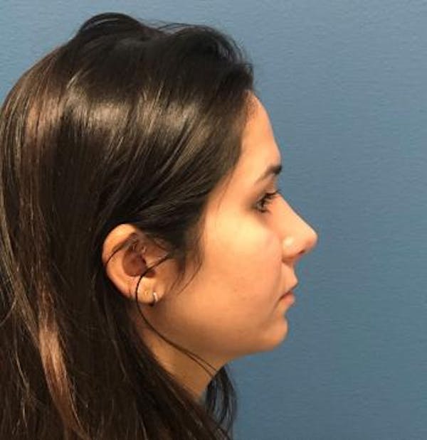 Aesthetic Rhinoplasty Before & After Gallery - Patient 5070483 - Image 6