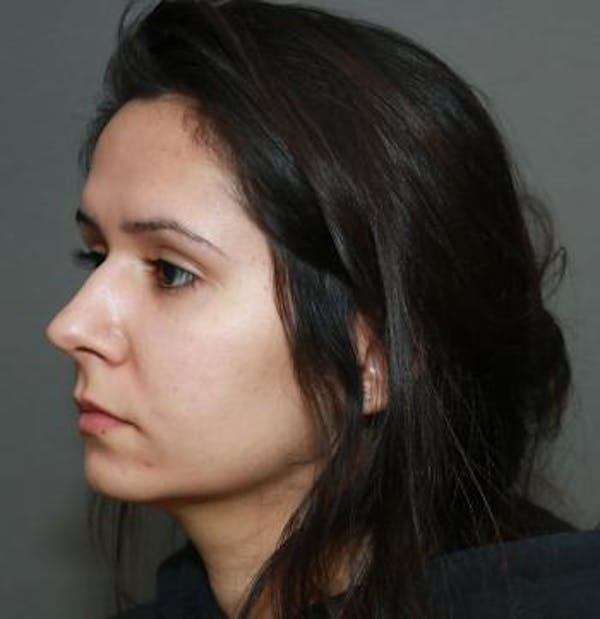 Aesthetic Rhinoplasty Before & After Gallery - Patient 5070483 - Image 7