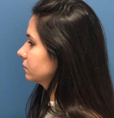 Aesthetic Rhinoplasty Before & After Gallery - Patient 5070483 - Image 8