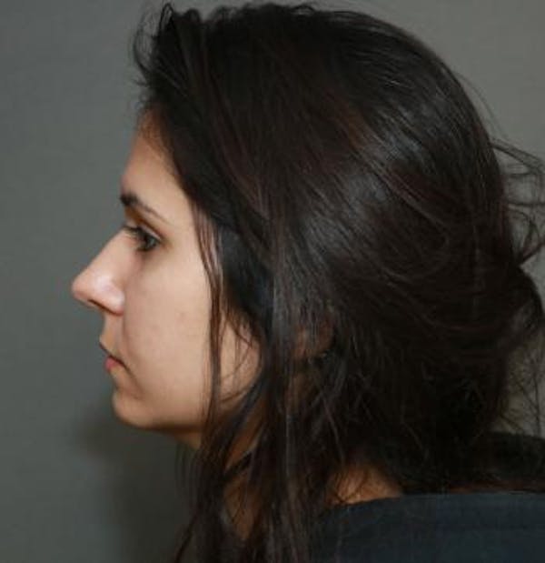 Aesthetic Rhinoplasty Before & After Gallery - Patient 5070483 - Image 11