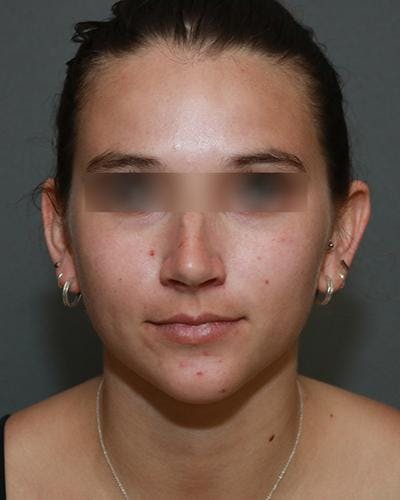 Aesthetic Rhinoplasty Before & After Gallery - Patient 5070488 - Image 1