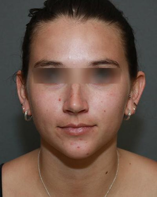 Aesthetic Rhinoplasty Before & After Gallery - Patient 5070488 - Image 1