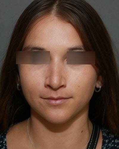 Aesthetic Rhinoplasty Before & After Gallery - Patient 5070488 - Image 2