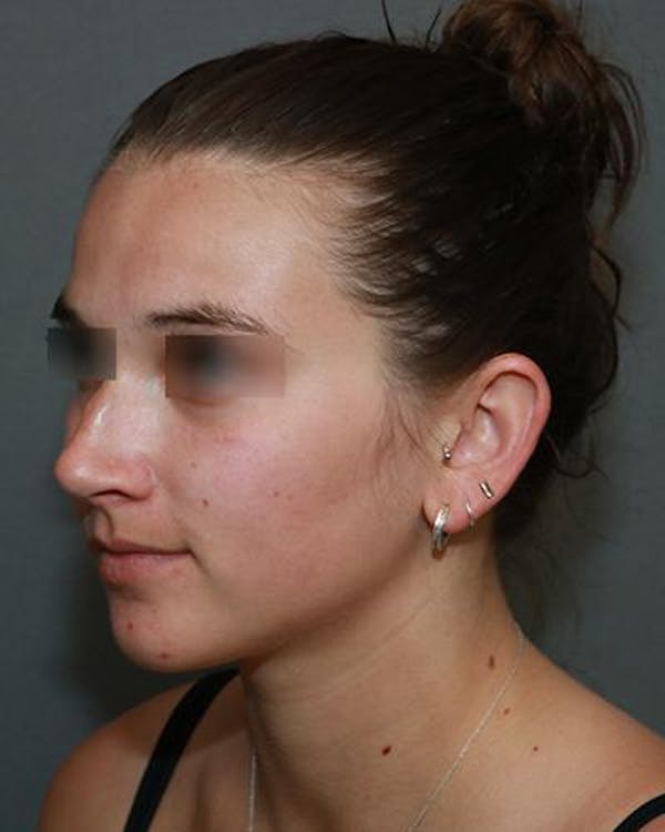 Aesthetic Rhinoplasty Before & After Gallery - Patient 5070488 - Image 3