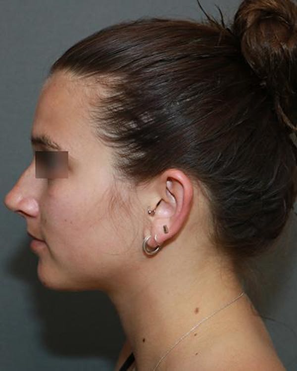 Aesthetic Rhinoplasty Before & After Gallery - Patient 5070488 - Image 5