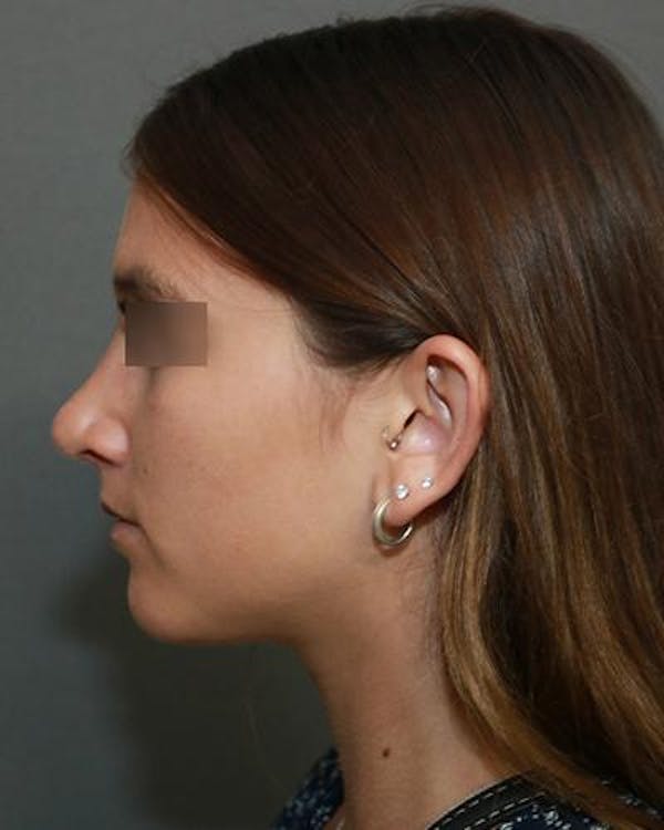 Aesthetic Rhinoplasty Before & After Gallery - Patient 5070488 - Image 6