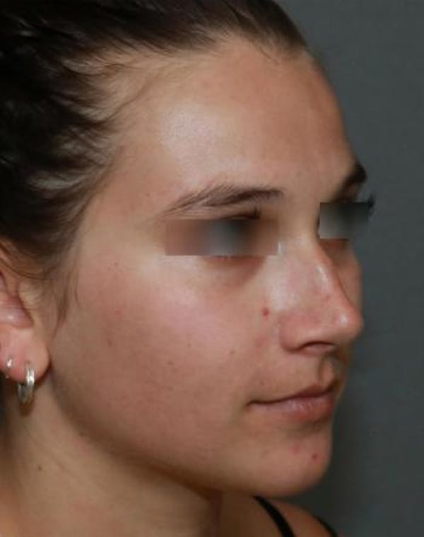 Aesthetic Rhinoplasty Before & After Gallery - Patient 5070488 - Image 7
