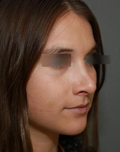 Aesthetic Rhinoplasty Before & After Gallery - Patient 5070488 - Image 8