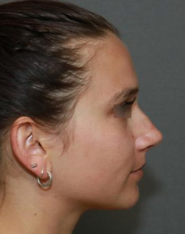 Aesthetic Rhinoplasty Before & After Gallery - Patient 5070488 - Image 9