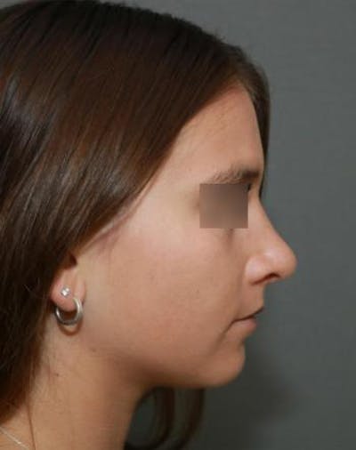 Aesthetic Rhinoplasty Before & After Gallery - Patient 5070488 - Image 10