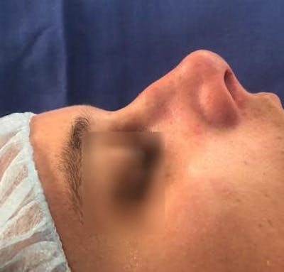 Aesthetic Rhinoplasty Before & After Gallery - Patient 5070492 - Image 1