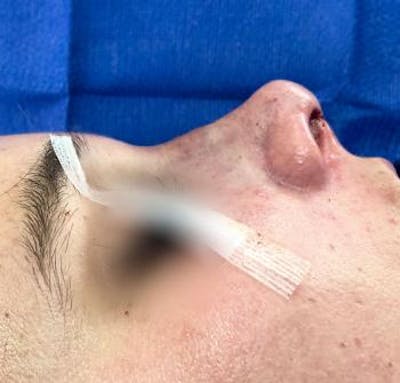 Aesthetic Rhinoplasty Before & After Gallery - Patient 5070492 - Image 2