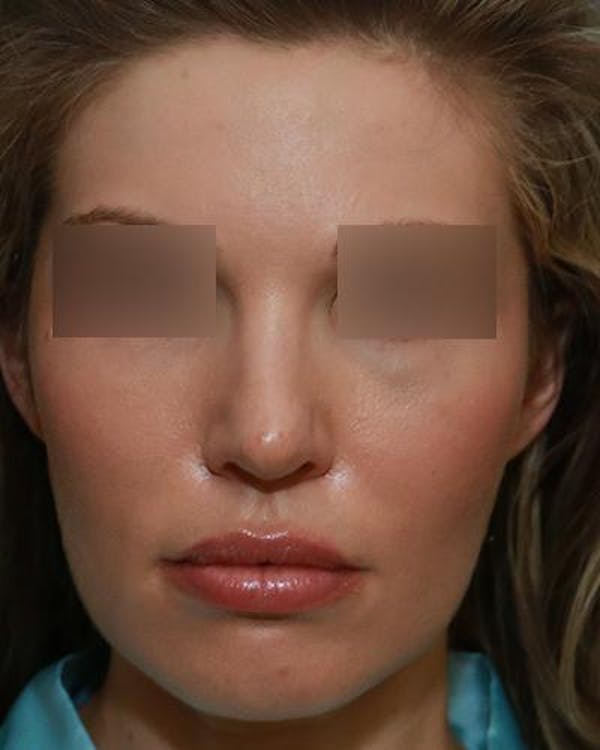 Aesthetic Rhinoplasty Before & After Gallery - Patient 5070495 - Image 1