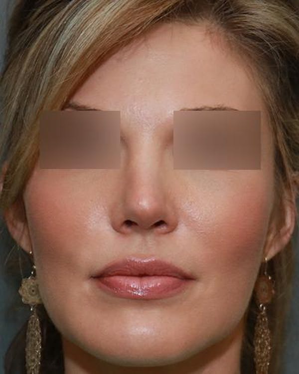 Aesthetic Rhinoplasty Before & After Gallery - Patient 5070495 - Image 2