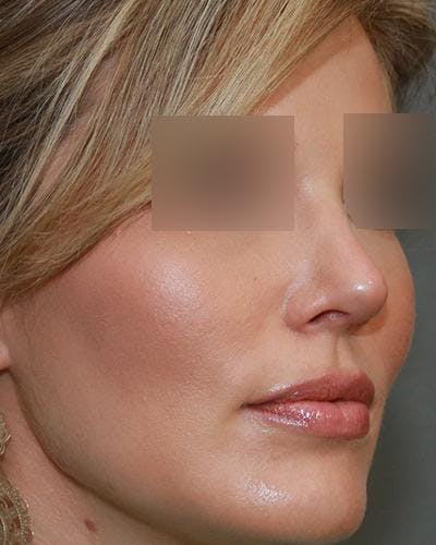 Aesthetic Rhinoplasty Before & After Gallery - Patient 5070495 - Image 4
