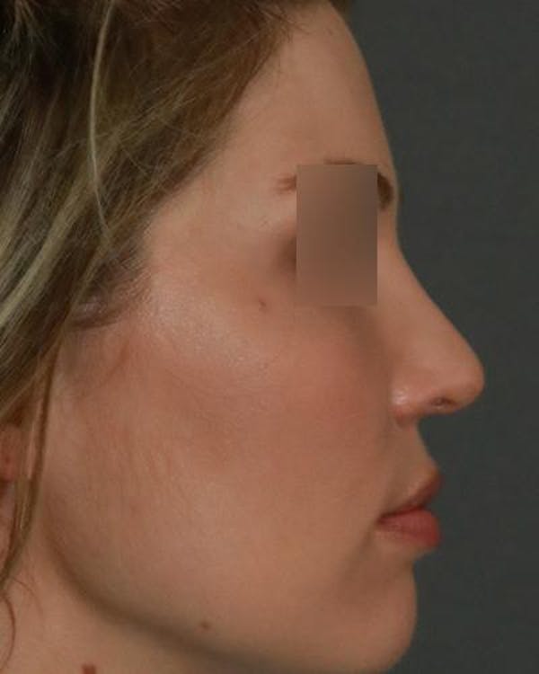 Aesthetic Rhinoplasty Before & After Gallery - Patient 5070495 - Image 5