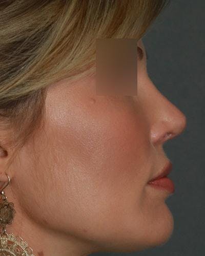 Aesthetic Rhinoplasty Before & After Gallery - Patient 5070495 - Image 6
