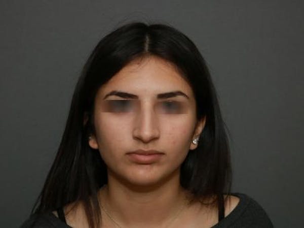 Before and After of Ethnic Rhinoplasty