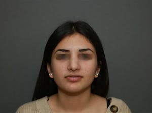 Before and After of Ethnic Rhinoplasty